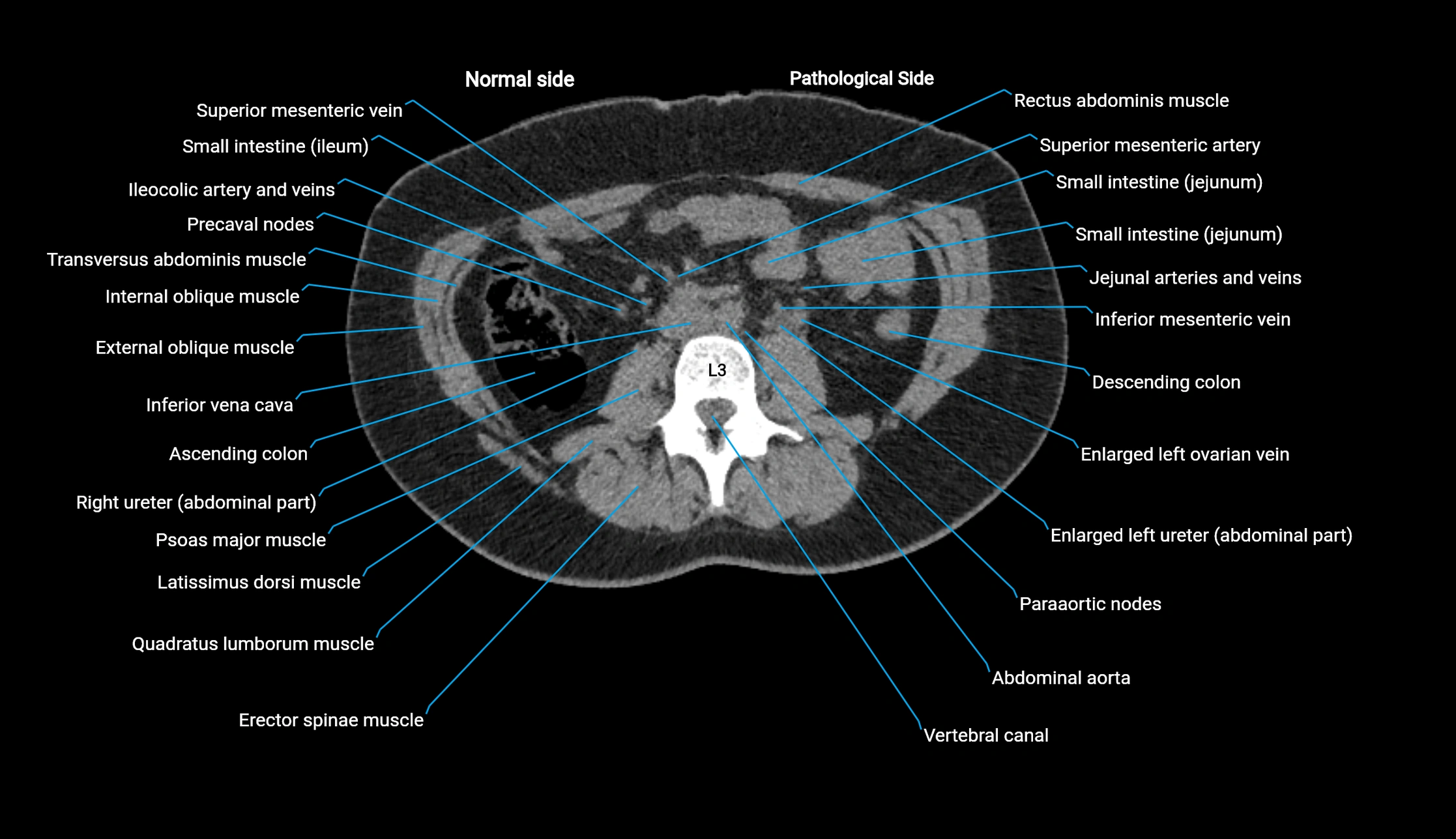CT KUB axial cross sectional anatomy  radiology image -img-00201-00070.webp